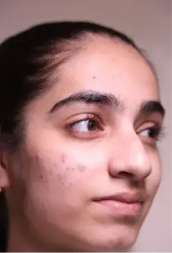 Acne Arrestor Facial With Salicylic Peel Before