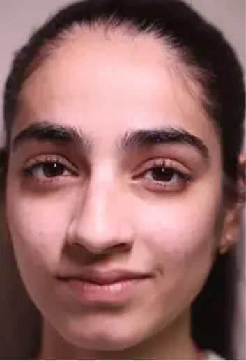 Acne Arrestor Facial With Salicylic Peel After