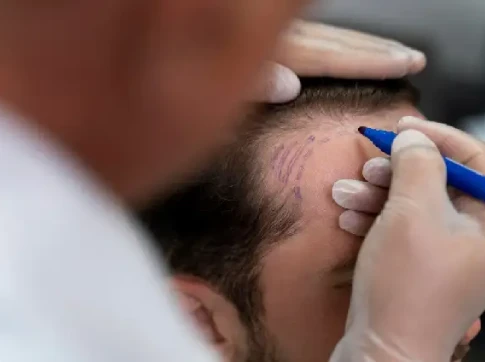 Benefits of Follicular Unit Transplant over other methods