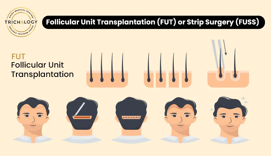 Hair transplantation is not a good option for: