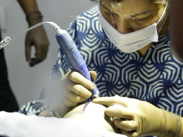Benefits of Direct Hair Transplant Over Other Methods