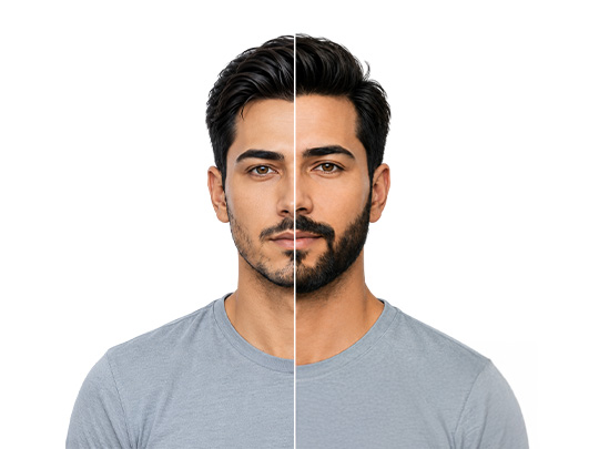 Beard Hair Transplant