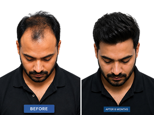 FUE Hair Transplant