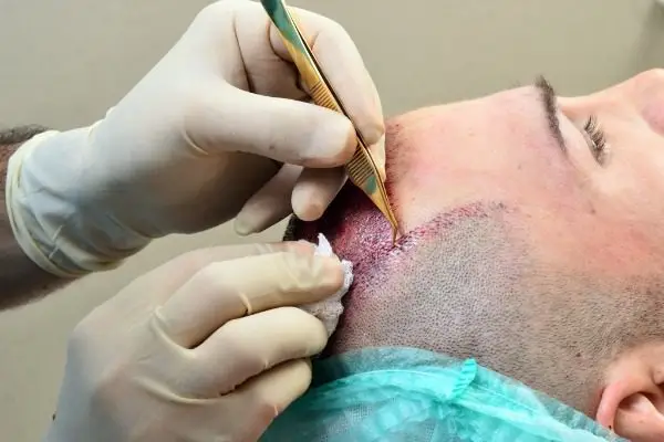 BENEFITS OF HAIR TRANSPLANT IN DELHI