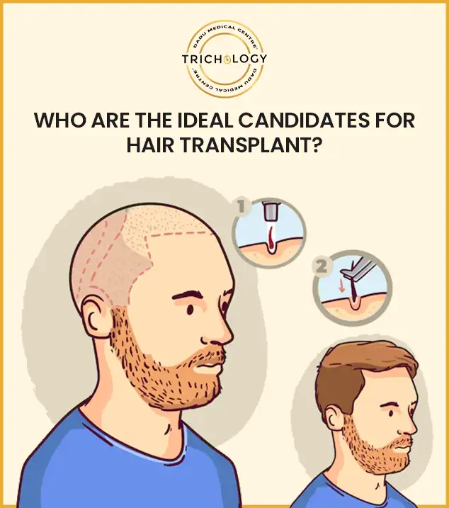 IDEAL CANDIDATES FOR HAIR TRANSPLANT